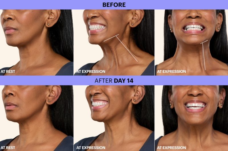 FDA Approved Treatments for the Neck with Botox