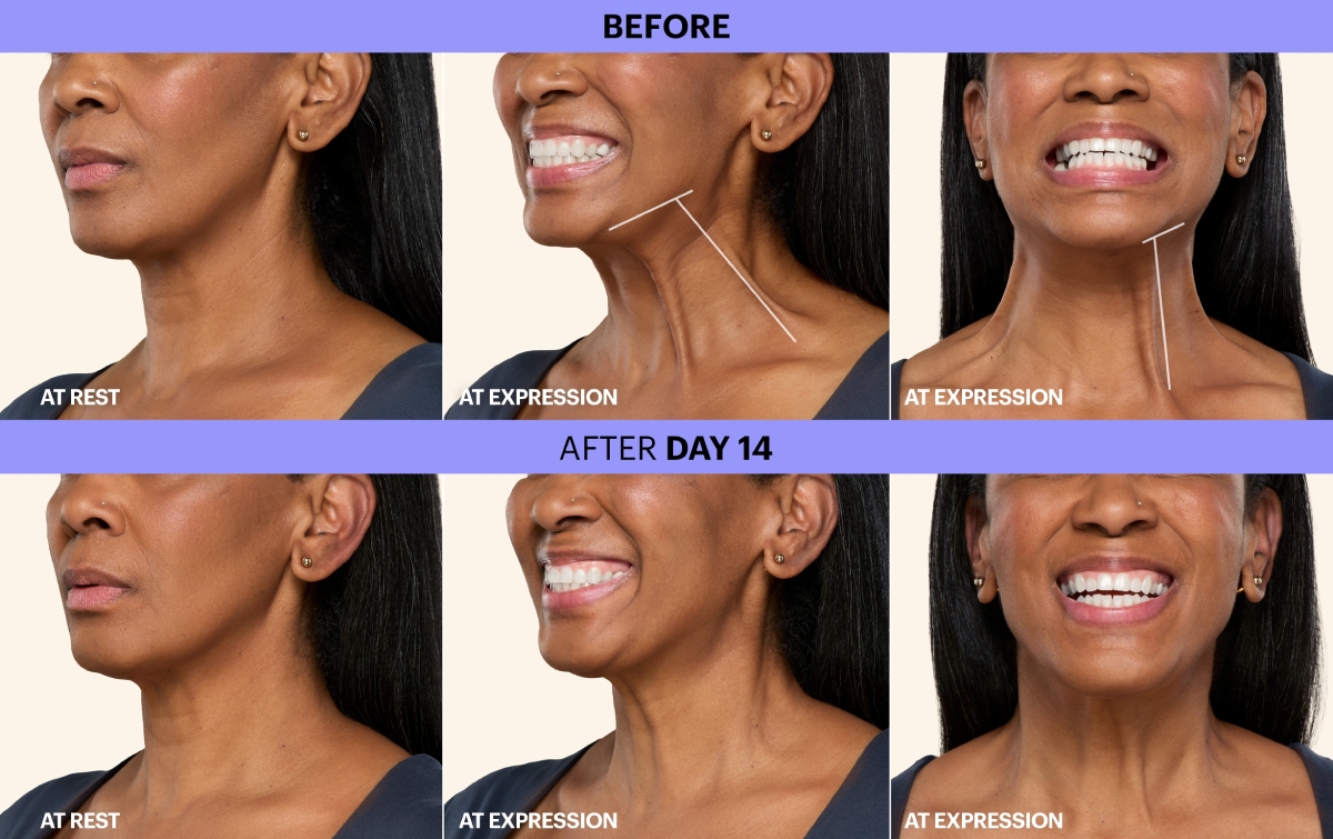 FDA Approved Treatments for the Neck with Botox