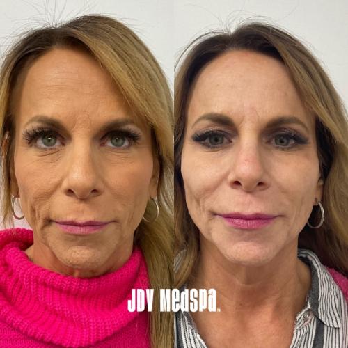 Before After Feb17 2025jpg (6)