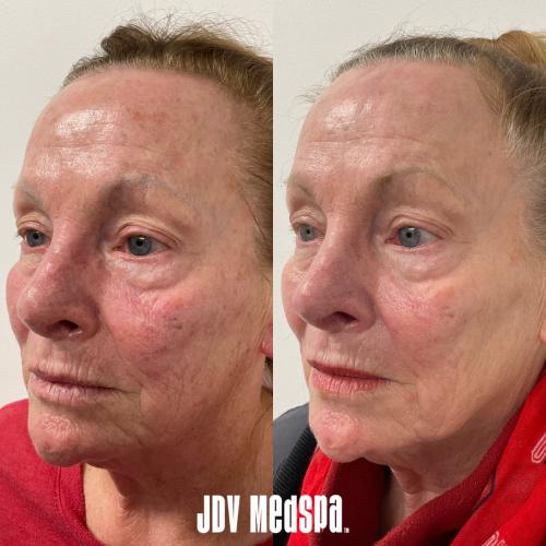 Before-After Jan 17 2025 (1)