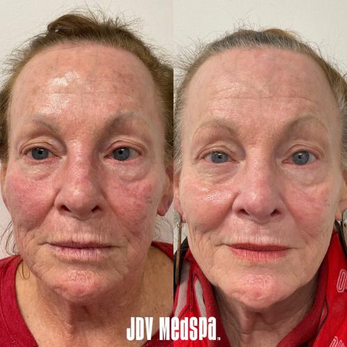 Before-After Jan 17 2025 (2)