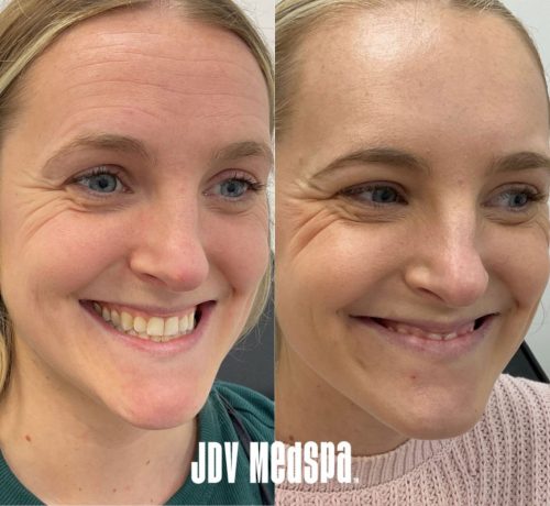 Botox-Upper-Face