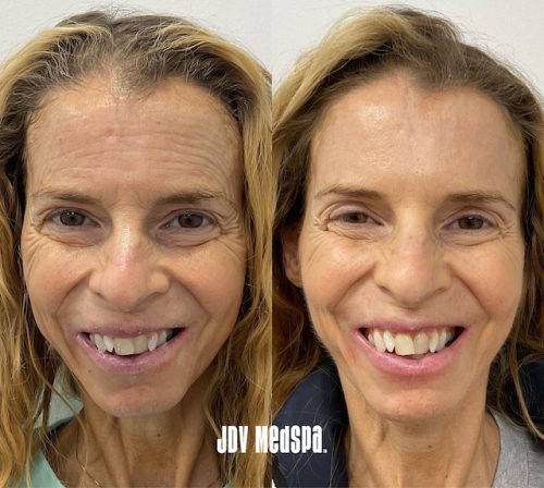 DysportUpper-Face