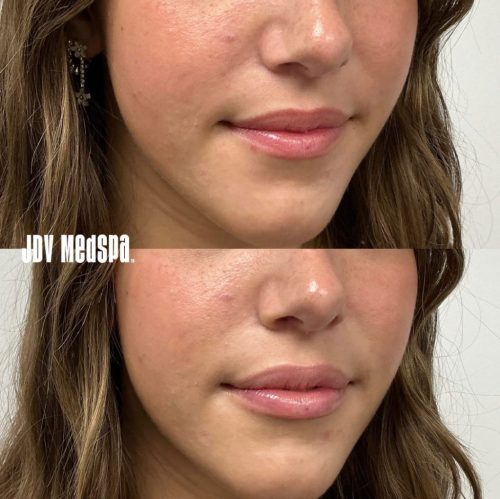 JDV-Mini-Lip