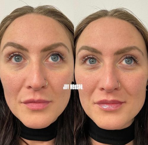 Lip-filler-Before-After