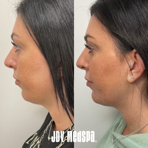 Profile-enhancement-chin-filler-and-smooth-threads