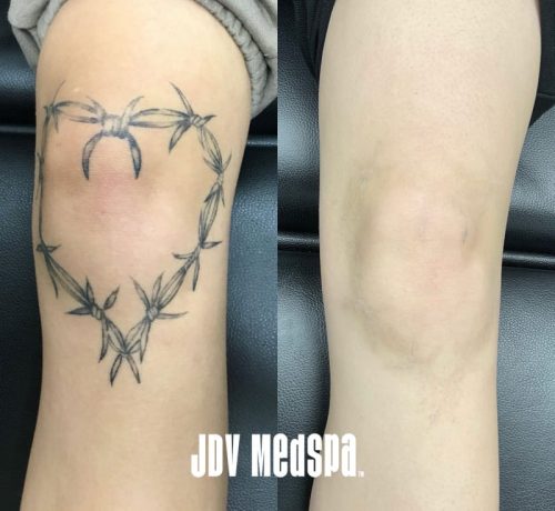 Tattoo-Removal-Feb