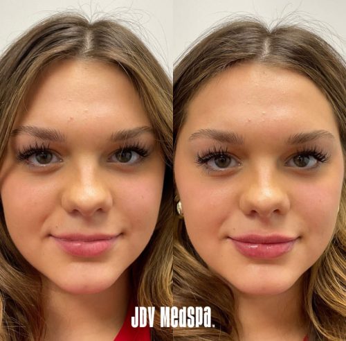 before-after-17march