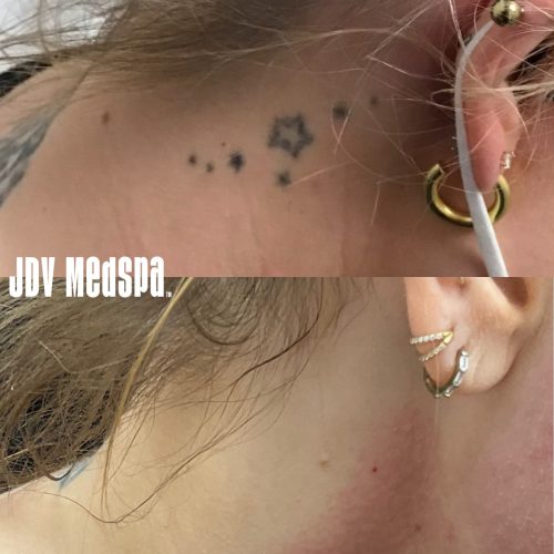 laser_tattoo_removal_picosure_by_cynosure