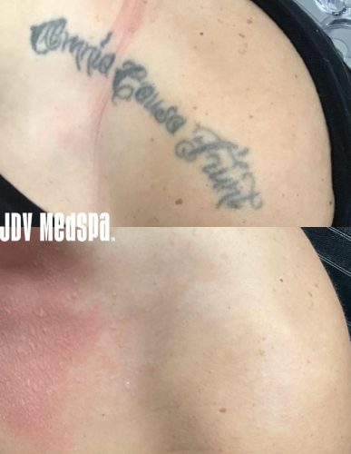picosure_laser_tattoo_removal